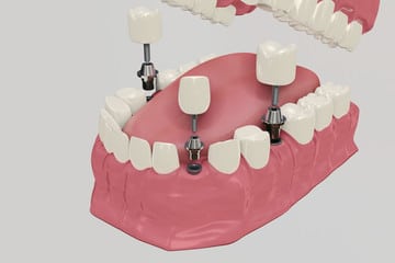 impianto dentale procedura