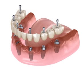 impianto denti con viti