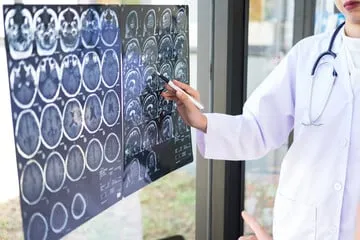 malattie neurologiche